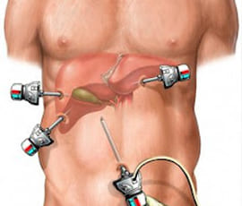 Colecistectomía laparoscópica